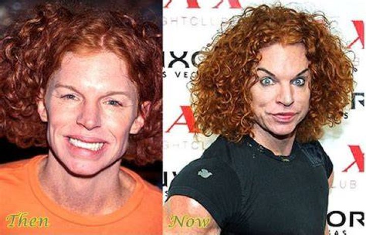 Carrot Top before and after surgery claim photo