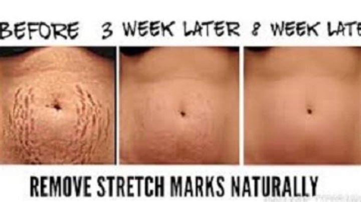 How to clear stretch marks naturally