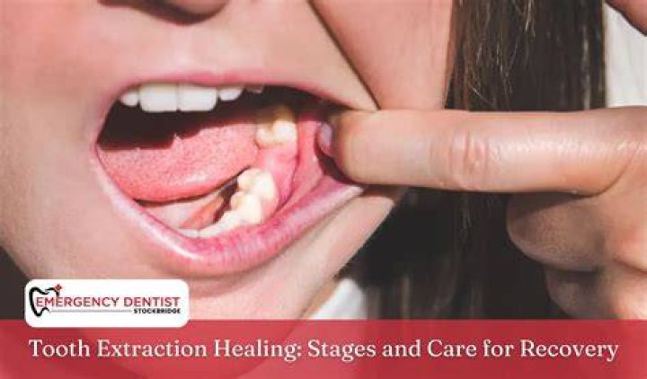 Recovery Period After Tooth Extraction